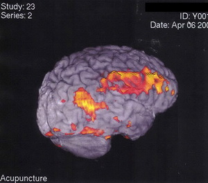 MRI brain on acupuncture